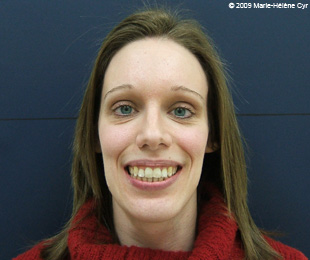 Marie-Hélène Cyr - Après des traitements d'orthodontie et des chirurgies orthognatiques (10 février 2009)